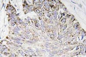 Immunohistochemistry (IHC) analyzes of Caspase-4 antibody in paraffin-embedded human lung carcinoma tissue. (Caspase 4 anticorps)