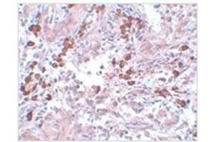 Immunohistochemistry of BCAS1 in human breast carcinoma with BCAS1 antibody at 5 µg/ml. (BCAS1 anticorps  (C-Term))