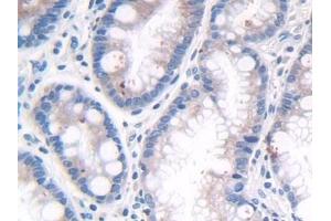 Detection of LRP4 in Human Stomach cancer Tissue using Polyclonal Antibody to Low Density Lipoprotein Receptor Related Protein 4 (LRP4)