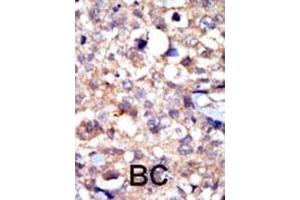 Formalin-fixed and paraffin-embedded human cancer tissue reacted with the primary antibody, which was peroxidase-conjugated to the secondary antibody, followed by AEC staining. (ABL1 anticorps  (C-Term))