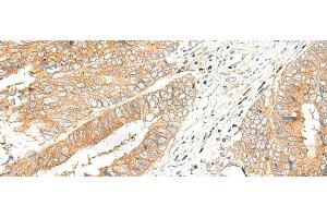 Immunohistochemistry of paraffin-embedded Human colorectal cancer tissue using GPR151 Polyclonal Antibody at dilution of 1:45(x200) (GPR151 anticorps)