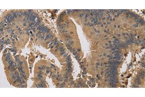 Immunohistochemistry of paraffin-embedded Human colon cancer using KIF22 Polyclonal Antibody at dilution of 1:30 (KIF22 anticorps)