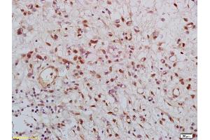 Formalin-fixed and paraffin embedded human gastric carcinoma labeled with Rabbit Anti KLK8 Polyclonal Antibody, Unconjugated (ABIN759116) at 1:200 followed by conjugation to the secondary antibody and DAB staining