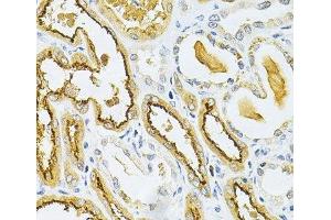Immunohistochemistry of paraffin-embedded Human kidney cancer using GLRX Polyclonal Antibody at dilution of 1:200 (40x lens). (Glutaredoxin 1 anticorps)