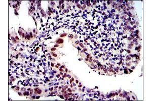Immunohistochemical analysis of paraffin-embedded intima cancer tissues using PSMB8 mouse mAb with DAB staining.
