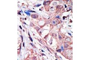 Formalin-fixed, Paraffin-embedded human cancer tissue stained with MAPK10 Antibody (N-term) Cat. (MAPK10 anticorps  (N-Term))