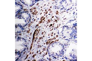 Anti-Mitochondrial Pyruvate dehydrogenase kinase 1 antibody, IHC(P) IHC(P): Human Prostatic Cancer Tissue (PDPK1 anticorps  (C-Term))
