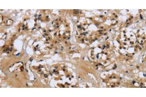 Immunohistochemistry of paraffin-embedded Human thyroid cancer tissue using LGALS7 Polyclonal Antibody at dilution 1:50 (LGALS7 anticorps)