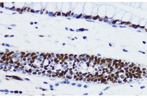 Immunohistochemistry of paraffin-embedded Human colon using Acetyl-Histone H2B-K12 Polyclonal Antibody at dilution of 1:200 (40x lens). (Histone H2B anticorps  (acLys12))