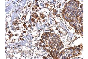 IHC-P Image HSP47 antibody [N2C2], Internal detects HSP47 protein at cytosol on human breast carcinoma by immunohistochemical analysis.