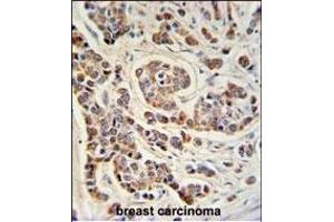 ATHL1 Antibody (C-term) (ABIN1881084 and ABIN2840111) IHC analysis in formalin fixed and paraffin embedded human breast carcinoma followed by peroxidase conjugation of the secondary antibody and DAB staining. (ATHL1 anticorps  (C-Term))