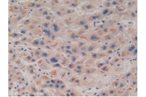 Detection of COIL in Human Liver Cancer Tissue using Polyclonal Antibody to Coilin (COIL)