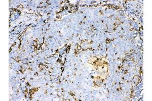 IHC testing of FFPE human lung cancer tissue with IBA1 antibody at 1ug/ml.