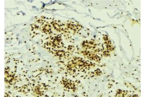 ABIN6273799 at 1/100 staining Human breast cancer tissue by IHC-P. (NEK2 anticorps  (Internal Region))