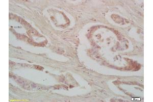 Formalin-fixed and paraffin embedded human colon carcinoma labeled with Rabbit Anti IRS-2 Polyclonal Antibody, Unconjugated (ABIN725840) at 1:200 followed by conjugation to the secondary antibody and DAB staining