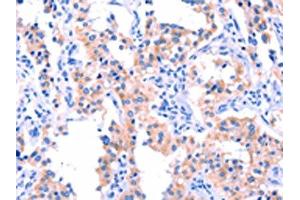 The image on the left is immunohistochemistry of paraffin-embedded Human thyroid cancer tissue using ABIN7190588(ERN2 Antibody) at dilution 1/40, on the right is treated with synthetic peptide. (ERN2 anticorps)