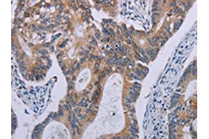 The image on the left is immunohistochemistry of paraffin-embedded Human colon cancer tissue using ABIN7190614(F2RL2 Antibody) at dilution 1/30, on the right is treated with synthetic peptide. (F2RL2 anticorps)