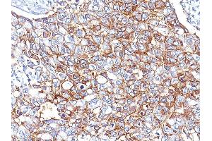 Formalin-fixed, paraffin-embedded human Breast Carcinoma stained with EpCAM Mouse Monoclonal Antibody (EGP40/826). (EpCAM anticorps  (N-Term))