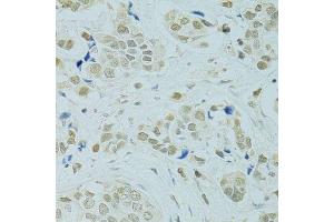 Immunohistochemistry of paraffin-embedded human breast cancer using RCC1 antibody. (RCC1 anticorps  (AA 1-240))
