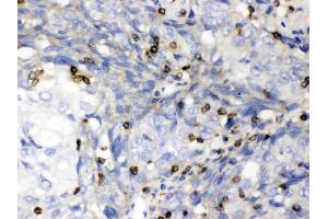 ABL2 was detected in paraffin-embedded sections of human lung cancer tissues using rabbit anti- ABL2 Antigen Affinity purified polyclonal antibody (Catalog # ) at 1 µg/mL.