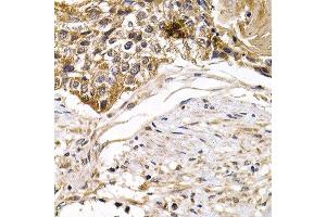 Immunohistochemistry of paraffin-embedded human breast cancer using ARRB2 antibody at dilution of 1:200 (400x lens).