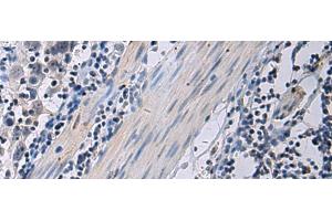 Immunohistochemistry of paraffin-embedded Human esophagus cancer tissue using ANGPTL2 Polyclonal Antibody at dilution of 1:55(x200)