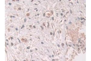 Detection of GCA in Human Prostate cancer Tissue using Polyclonal Antibody to Grancalcin (GCA)
