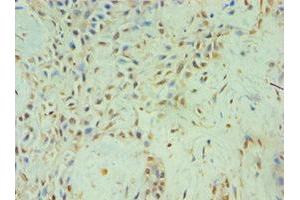 Immunohistochemistry of paraffin-embedded human breast cancer using ABIN7152459 at dilution of 1:100 (TBL1XR1 anticorps  (AA 1-180))