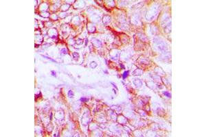 Immunohistochemical analysis of HER4 (pY1284) staining in human breast cancer formalin fixed paraffin embedded tissue section. (ERBB4 anticorps  (C-Term, pTyr1284))