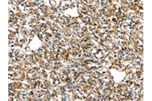 The image on the left is immunohistochemistry of paraffin-embedded Human prostate cancer tissue using ABIN7131341(TGM4 Antibody) at dilution 1/20, on the right is treated with fusion protein.