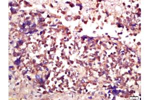 Formalin-fixed and paraffin embedded human lung carcinoma labeled with Anti-E2F3 Polyclonal Antibody, Unconjugated (ABIN733493) at 1:200 followed by conjugation to the secondary antibody and DAB staining (E2F3 anticorps  (AA 381-465))