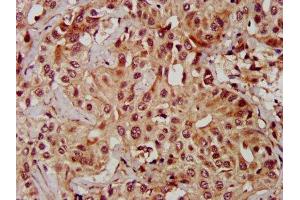 IHC image of ABIN7159972 diluted at 1:600 and staining in paraffin-embedded human liver cancer performed on a Leica BondTM system.