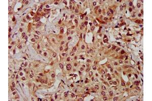 IHC image of ABIN7159972 diluted at 1:600 and staining in paraffin-embedded human liver cancer performed on a Leica BondTM system. (ERK2 anticorps  (AA 310-360))