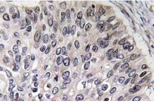 Immunohistochemistry analyzes of Carbonic anhydrase 2 antibody in paraffin-embedded human lung carcinoma tissue. (CA2 anticorps)