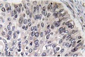 Immunohistochemistry analyzes of Carbonic anhydrase 2 antibody in paraffin-embedded human lung carcinoma tissue.