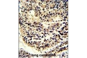 Formalin-fixed and paraffin-embedded human lung carcinoma reacted with BCL2A1 Antibody (Center), which was peroxidase-conjugated to the secondary antibody, followed by DAB staining. (BCL2A1 anticorps  (AA 53-81))