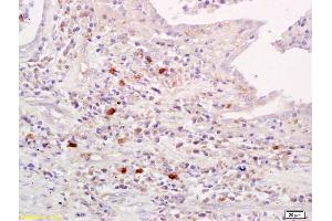 Formalin-fixed and paraffin embedded human lung carcinoma labeled with Anti-Amylin Polyclonal Antibody, Unconjugated (ABIN724280) at 1:200 followed by conjugation to the secondary antibody and DAB staining. (Amylin/DAP anticorps)