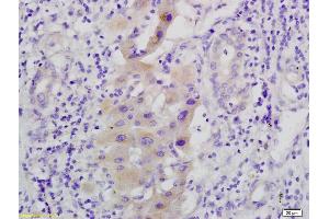 Formalin-fixed and paraffin embedded human hepatoma labeled with Anti-phospho C-Met/HGFR(Tyr1365), Unconjugated (ABIN733703) at 1:200, followed by conjugation to the secondary antibody and DAB staining
