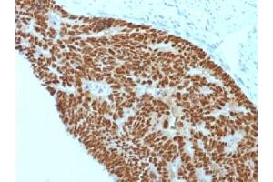 IHC testing of FFPE human colon carcinoma with CDX2 antibody (clone CDX2/1690).
