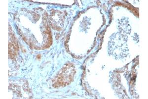 Formalin-fixed, paraffin-embedded human Prostate Carcinoma stained with TIGIT-Monospecific Mouse Monoclonal Antibody (TIGIT/3106). (TIGIT anticorps  (AA 22-141))