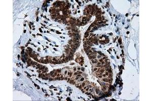 Immunohistochemical staining of paraffin-embedded breast tissue using anti-TPMT mouse monoclonal antibody. (TPMT anticorps)