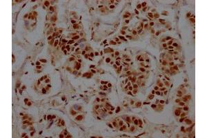 IHC image of ABIN7127789 diluted at 1:100 and staining in paraffin-embedded human breast cancer performed on a Leica BondTM system.