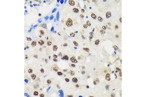 Immunohistochemistry of paraffin-embedded Human breast cancer using LB Rabbit pAb (ABIN6131871, ABIN6143090, ABIN6143091 and ABIN6217142) at dilution of 1:100 (40x lens). (LARP1B anticorps  (AA 170-320))