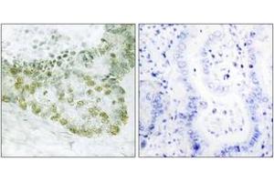 Immunohistochemistry analysis of paraffin-embedded human lung carcinoma tissue, using Hic-5 (Ab-60) Antibody.