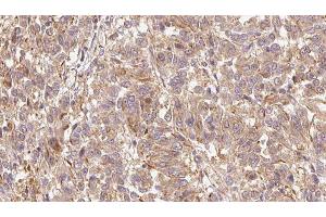 ABIN6279662 at 1/100 staining Human Melanoma tissue by IHC-P. (GPLD1 anticorps  (Internal Region))