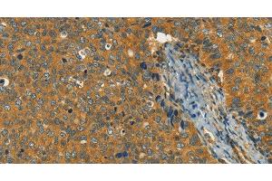 Immunohistochemistry of paraffin-embedded Human cervical cancer using KLC1 Polyclonal Antibody at dilution of 1:40 (KLC1 anticorps)