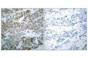 Immunohistochemical analysis of paraffin-embedded human breast carcinoma tissue using BAD(Phospho-Ser112) Antibody(left) or the same antibody preincubated with blocking peptide(right).