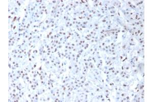 Formalin-fixed, paraffin-embedded human Mesothelioma stained with Wilm's Tumor Mouse Monoclonal Antibody (6F-H2). (WT1 anticorps  (AA 1-181))