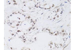 Immunohistochemistry of paraffin-embedded human gastric cancer using PAX3 antibody (ABIN6290725) at dilution of 1:100 (40x lens). (Paired Box 3 anticorps)