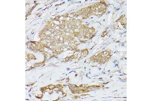 Immunohistochemistry of paraffin-embedded human breast cancer using Hsc70/HSP Rabbit pAb (ABIN3016123, ABIN3016124, ABIN3016125 and ABIN6219558) at dilution of 1:250 (40x lens).